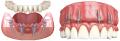 Implant dentar All on 4 si All on 6 Dental implants