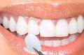 Fatete dentare