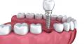 Implant-dentar-rapid-24h
