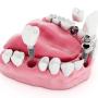 Model implant dentar 2
