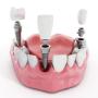 Model implant dentar