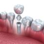 Implant dentar endo-osos