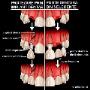 Implant versus punte dentara