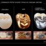 Comparatie intre diverse tipuri de coroane dentare
