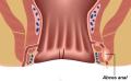 Abces-Perianal