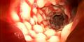 Boala-Crohn