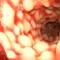 Boala-Crohn