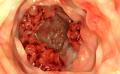 Cancer-Colon