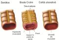 Colita Ulcerativa