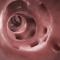 Diverticuloza