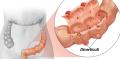 Diverticuloza