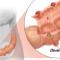 Diverticuloza