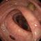 Diverticuloza