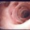 Diverticuloza