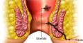 Fistula-perianala