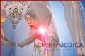 TRATAMENT-LOMBOSCIATICA