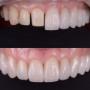 Fatete dentare la clinica de stomatologie estetica Dr Baldea TImisoara