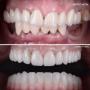 Inlocuire coroane dentare - reconstructie orala Dr. Baldea Timisoara