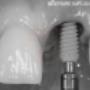 Inserarea unui implant dentar la Clinica dr. Baldea Timisoara
