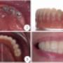 Proteza dentara pe implanturi Dr Baldea Dental Clinic Timisoara