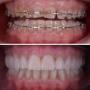 Tratament ortodontic la Clinica Dentara Dr. Baldea Timisoara