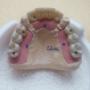 Proteza overdenture 23