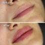 Before/After - Acid hialuronic buze