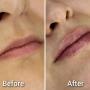 Before/After - Acid hialuronic buze