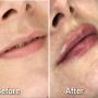 Before/After - Acid hialuronic buze