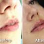 Before/After - Acid hialuronic buze