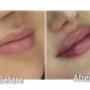 Before/After - Acid hialuronic buze
