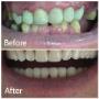 Before/After - Caz de restaurare totala a arcadelor dentare cu lucrări metalo-ceramice