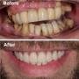 Before/After - Dinti ficsi in 24 ore Prodent