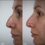 Before/After - Rinocorectie/Rinoplastie nechirurgicala