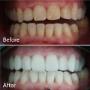Before/After - fatete e.max + albire dentara arcada inferioara