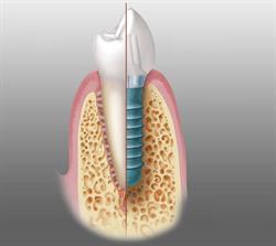 CMI Lapadat Hortensia Dent Implant Expert