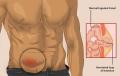 Câte tipuri de hernii exista şi care sunt caracteristicile fiecăreia