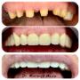 Coroane Metalo Ceramice Total Fizionomice