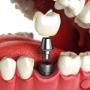 IMPLANT DENTAR