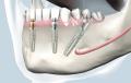 implanturi-dentare
