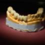 Lucrare Protetica Metalo-Ceramica