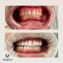 Fatete dentare