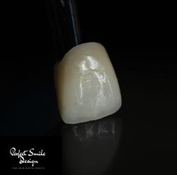 Perfect Smile Design