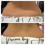 Liposonix flancuri