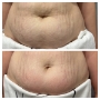 Liposonix