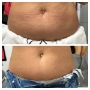 Liposonix