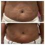 Liposonix