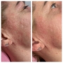 Fusion plasma dermatită