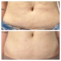 Liposonix