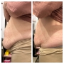 Liposonix